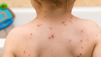 Baby:7sqqnv_Fzis= Chicken Pox