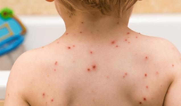 Baby:7sqqnv_Fzis= Chicken Pox